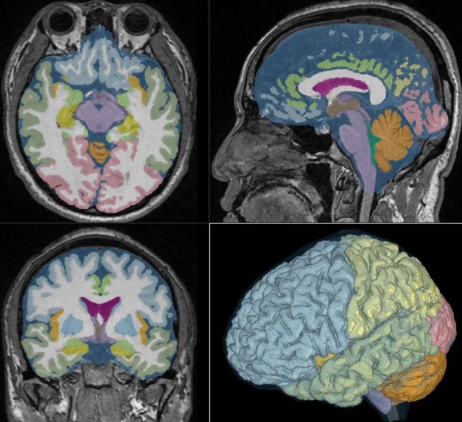 Figure 3 – Cerebrospinal fluid MRI scan where different areas of the brain are colour-coded using DL (‘Aging-related volume changes in the brain and cerebrospinal fluid using AI-automated segmentation - AI Blog - ESR | European Society of Radiology %’, no date)